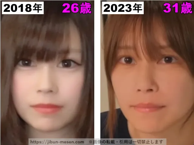 じゅえりーの唇の整形検証2018年〜2023年