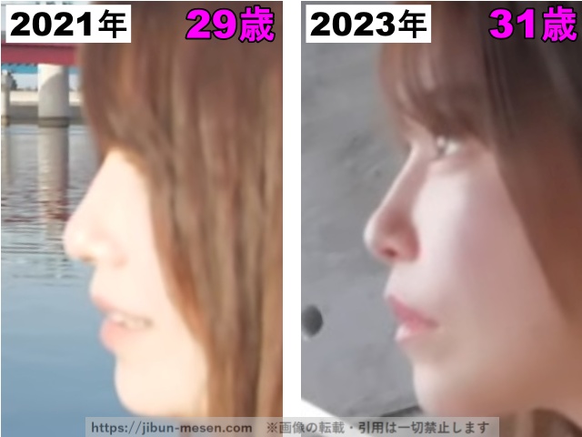 じゅえりーの鼻の整形検証2021年〜2023年(横顔)の画像