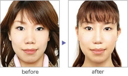 小鼻縮小による鼻の整形例(品川美容外科HPより引用)