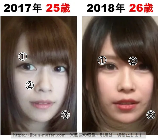 じゅえりーの整形検証2017年〜2018年