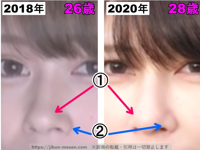 じゅえりーの鼻の整形検証2018年〜2020年(拡大)の画像