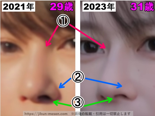 じゅえりーの鼻の整形検証2021年〜2023年(拡大)の画像