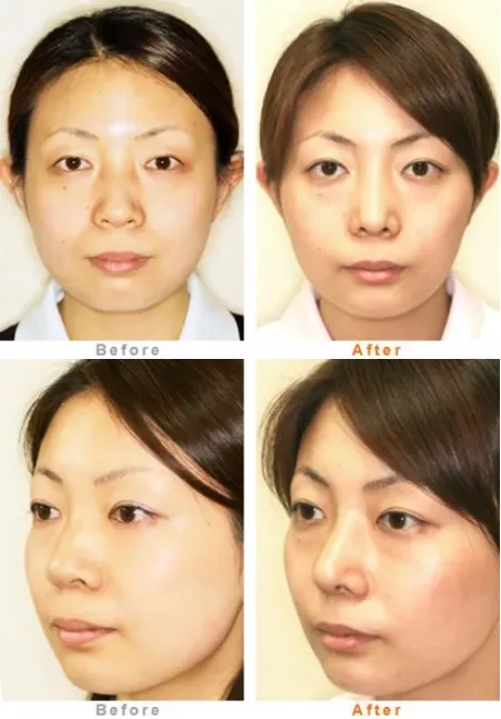 鼻尖縮小術による鼻の整形例(ユークリニックHPより引用)