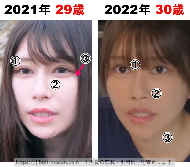 じゅえりーの整形検証2021年〜2022年