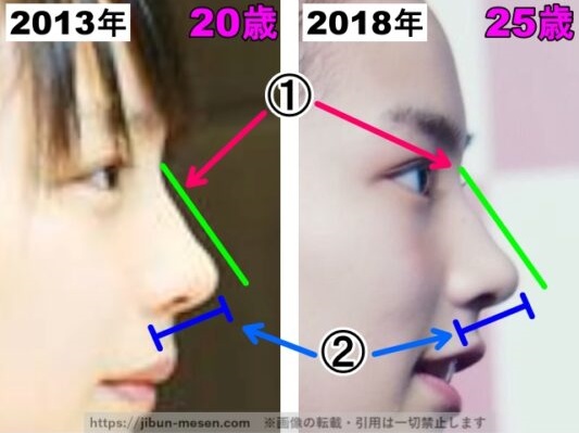 能年玲奈（のん）の鼻の整形検証2013年〜2018年（横顔・拡大）の画像