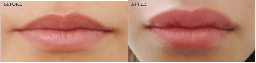 ヒアルロン酸注射による唇の整形例の画像