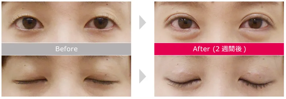 二重埋没法による目の整形例(品川美容外科HPより引用)