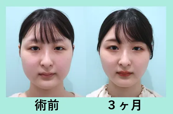 頬の脂肪吸引による輪郭の整形例(WOM CLINIC GINZA HPより引用)