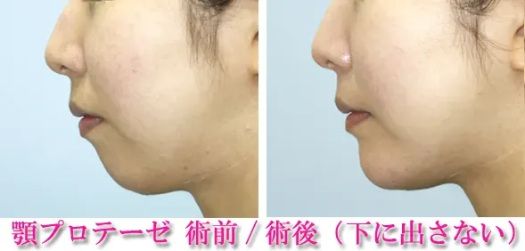 顎プロテーゼによる顎の整形例(ヤスミクリニックHPより引用)