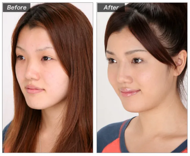 鼻プロテーゼによる鼻の整形例(城本クリニックHPより引用)