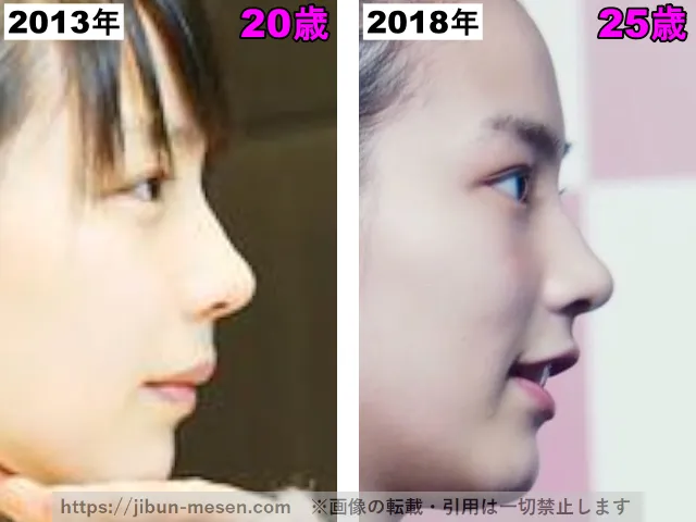 能年玲奈（のん）の鼻の整形検証2013年〜2018年（横顔）
