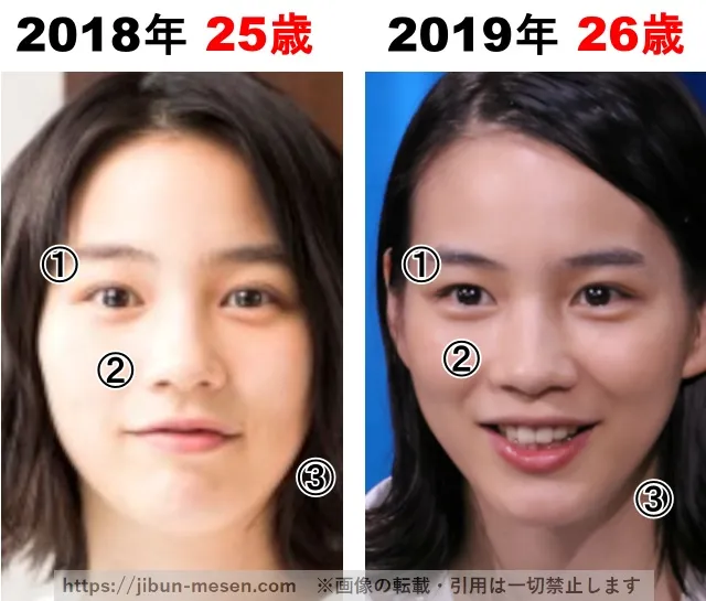 能年玲奈(のん)の整形検証2018年〜2019年