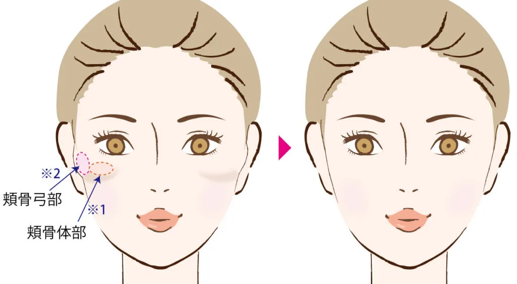 頬骨体部と頬骨弓部(MIYAフェイスクリニックHPより引用)