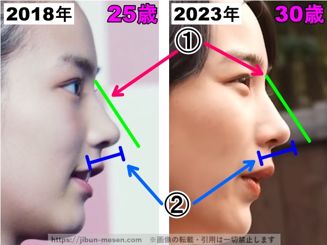 能年玲奈（のん）の鼻の整形検証2018年〜2023年（横顔・拡大）の画像