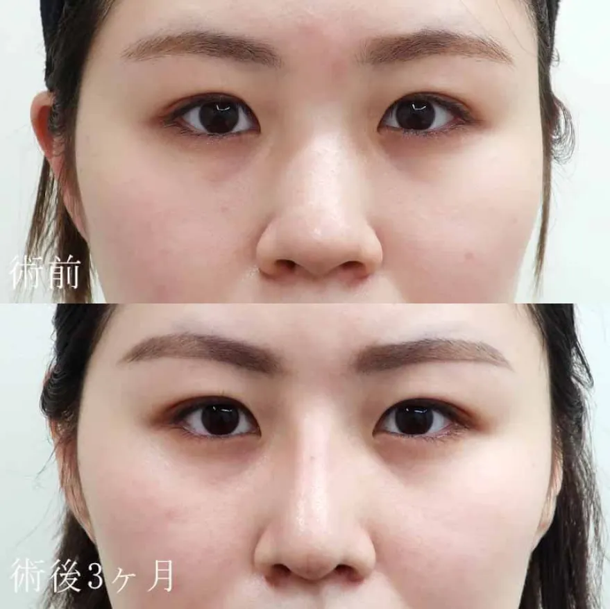 耳介軟骨移植術による鼻の整形例(水の森美容クリニックHPより引用)