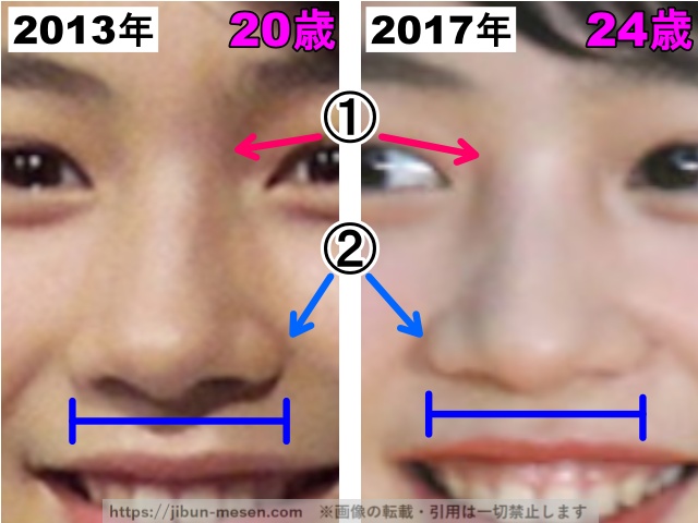 能年玲奈（のん）の鼻の整形検証20013年〜2017年（拡大）の画像