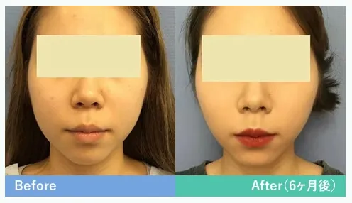 バッカルファット除去による輪郭の整形例(湘南美容クリニックHPより引用)