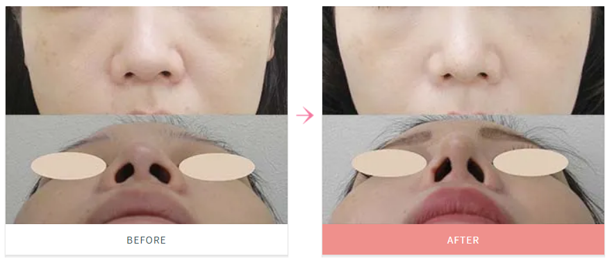 鼻尖縮小術による鼻の整形例の画像