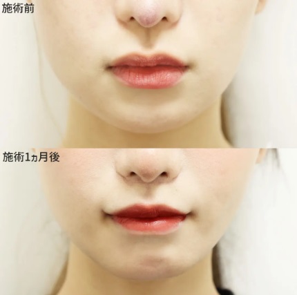 口唇縮小術による唇の整形例の画像