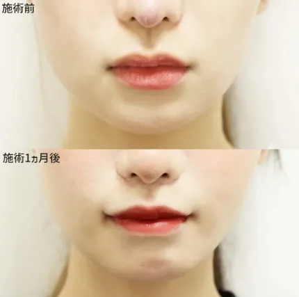 口唇縮小術による唇の整形例(TAクリニックグループHPより引用)