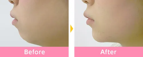 ヒアルロン酸注射による顎の整形例(品川美容外科HPより引用)