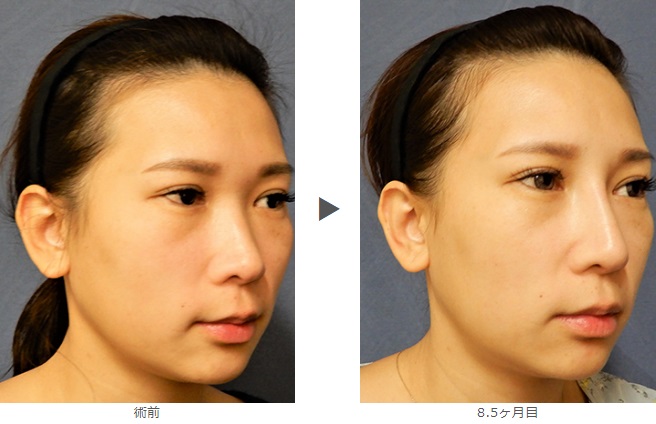 鼻プロテーゼによる鼻の整形例(横浜エーブクリニックHPより引用)の画像