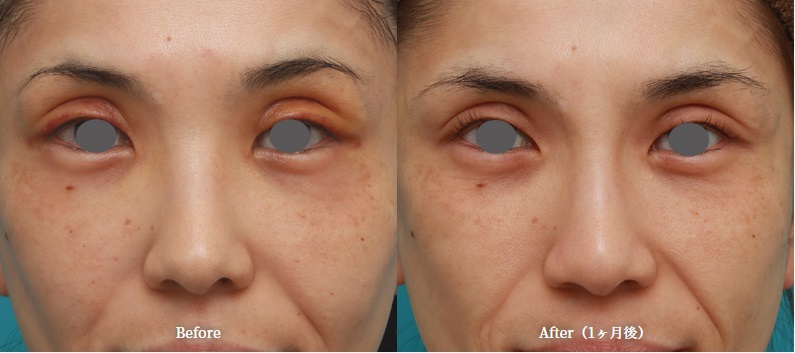 ヒアルロン酸注射による鼻の整形例(高須クリニックHPより引用)の画像