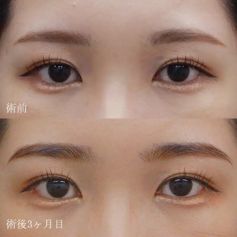 目尻切開による目の整形例(水の森美容クリニックHPより引用)の画像