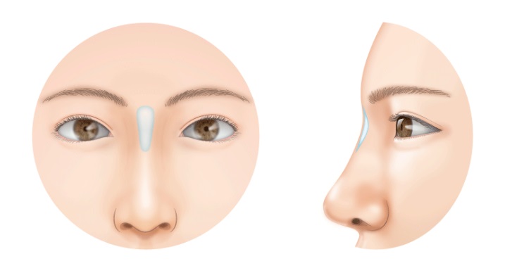 鼻根部へのヒアルロン酸注入(高須クリニックHPより引用)の画像