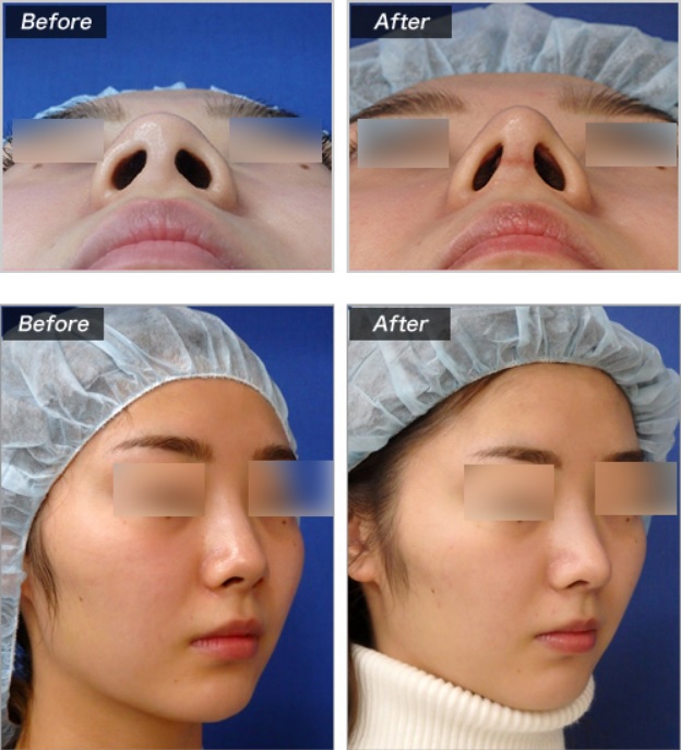 鼻中隔延長による鼻の整形例(城本クリニックHPより引用)の画像