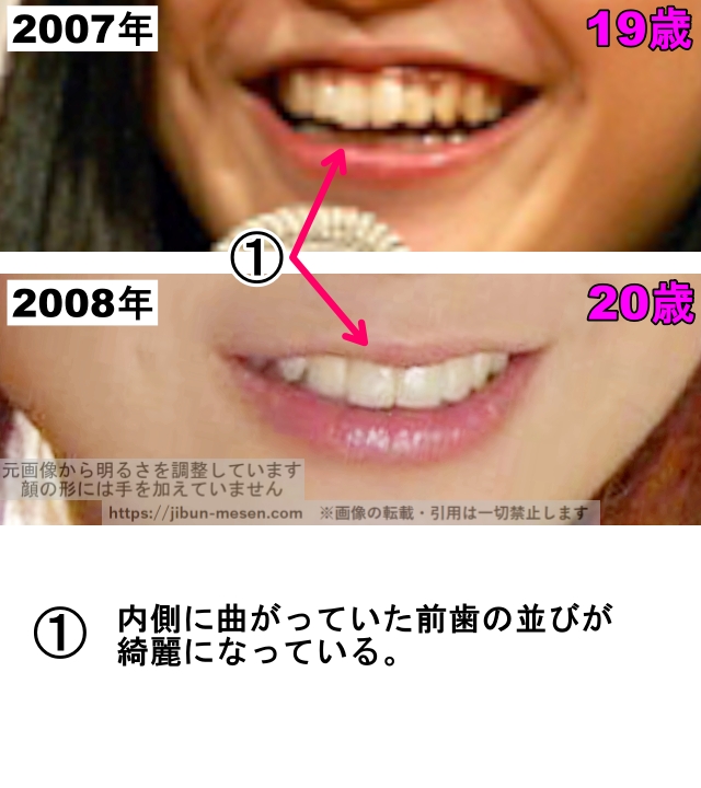 吉高由里子の口の整形検証2007年〜2008年（拡大）の画像