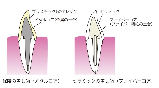 差し歯の構造(りょうき歯科クリニック公式ブログより引用)の画像