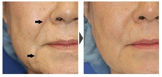 ベビーコラーゲン注射による肌の整形例(新宿ラクル美容外科クリニックHPより引用)の画像
