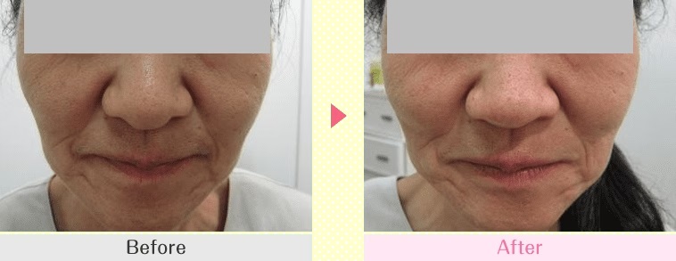鼻柱挙上術による鼻の整形例(湘南美容クリニックHPより引用)の画像