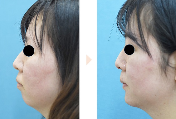 顎プロテーゼによる顎の整形例(みずほクリニックHPより引用)の画像