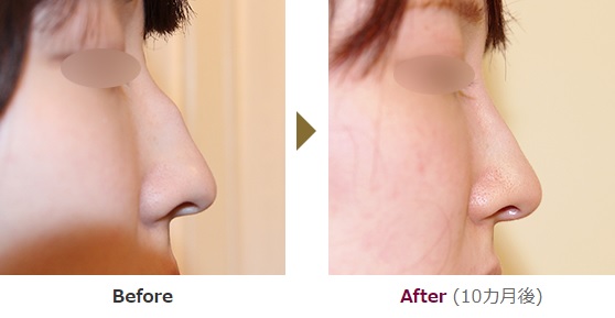 ワシ鼻修正による鼻の整形例(ヒルズ美容クリニックHPより引用)の画像