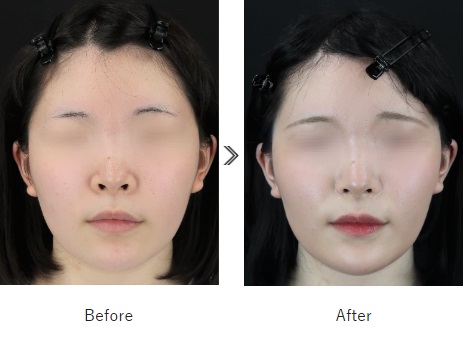 小鼻縮小術による鼻の整形例(タイデスエナガクリニックHPより引用)の画像