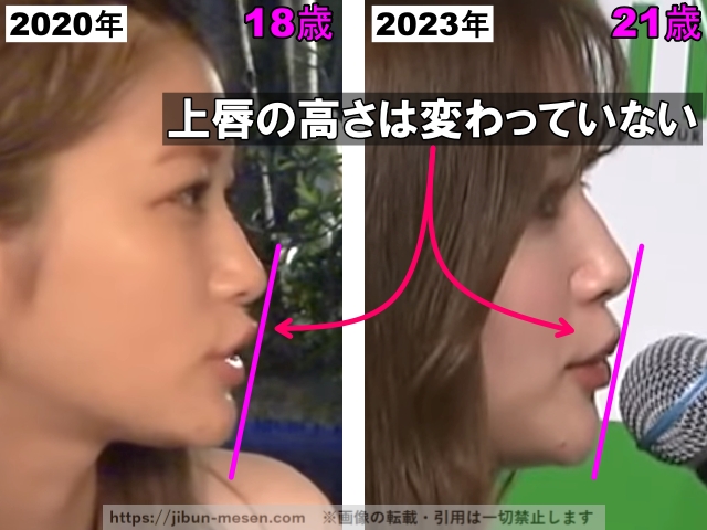 上唇の高さは変わっていない