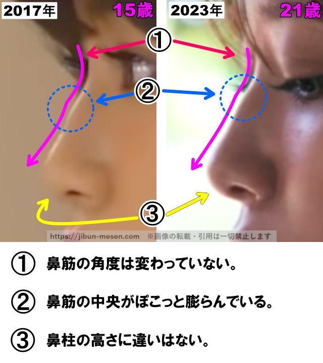 1 鼻筋の角度は変わっていない。2 鼻筋の中央がぽこっと膨らんでいる。 3 鼻柱の高さに違いはない。