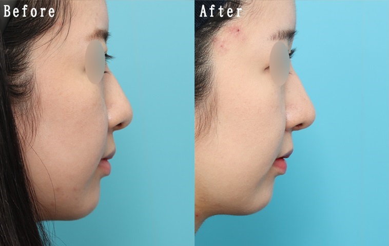鼻尖形成術による鼻の整形例(ヴェリテクリニックHPより引用)の画像