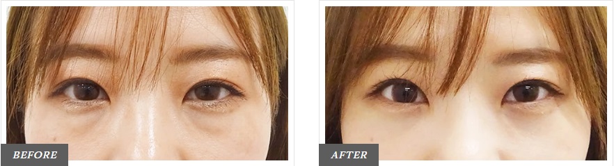 ベビーコラーゲン注射による目の整形例(東京中央美容外科HPより引用)の画像