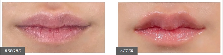 M字リップ形成術による唇の整形例(東京中央美容外科HPより引用)の画像