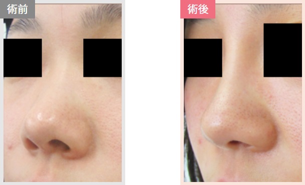 鼻プロテーゼによる鼻の整形例（ユリシスクリニックHPより引用）の画像