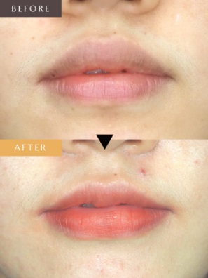 口唇縮小術による唇の整形例（ルシアクリニックHPより引用）の画像