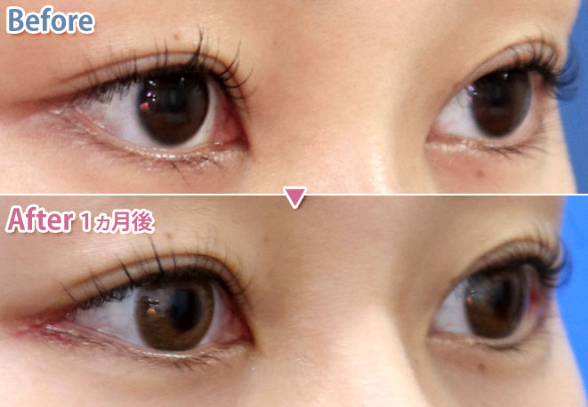 目尻切開による目の整形例(あつぎ美容クリニックHPより引用)の画像