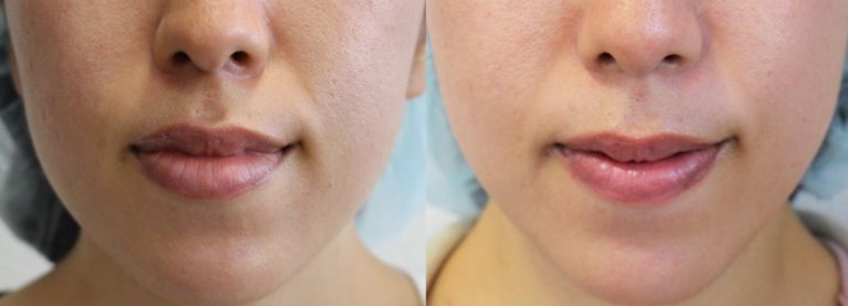 口唇縮小術による唇の整形例（船橋中央クリニックHPより引用）の画像