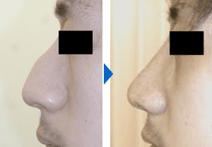 ワシ鼻修正による鼻の整形例（銀座みゆき通り美容外科大阪院HPより引用）の画像