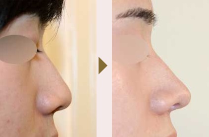 鼻尖形成術による鼻の整形例（ヒルズ美容クリニックHPより引用）の画像