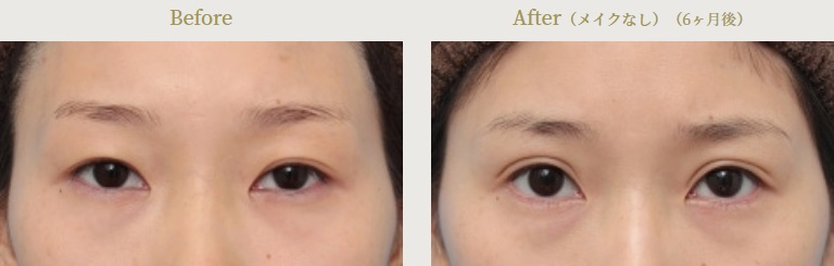 下眼瞼開大術による目の整形例（高須クリニックHPより引用）の画像
