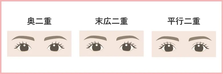 二重まぶたの種類（サクラアズクリニックHPより引用）の画像